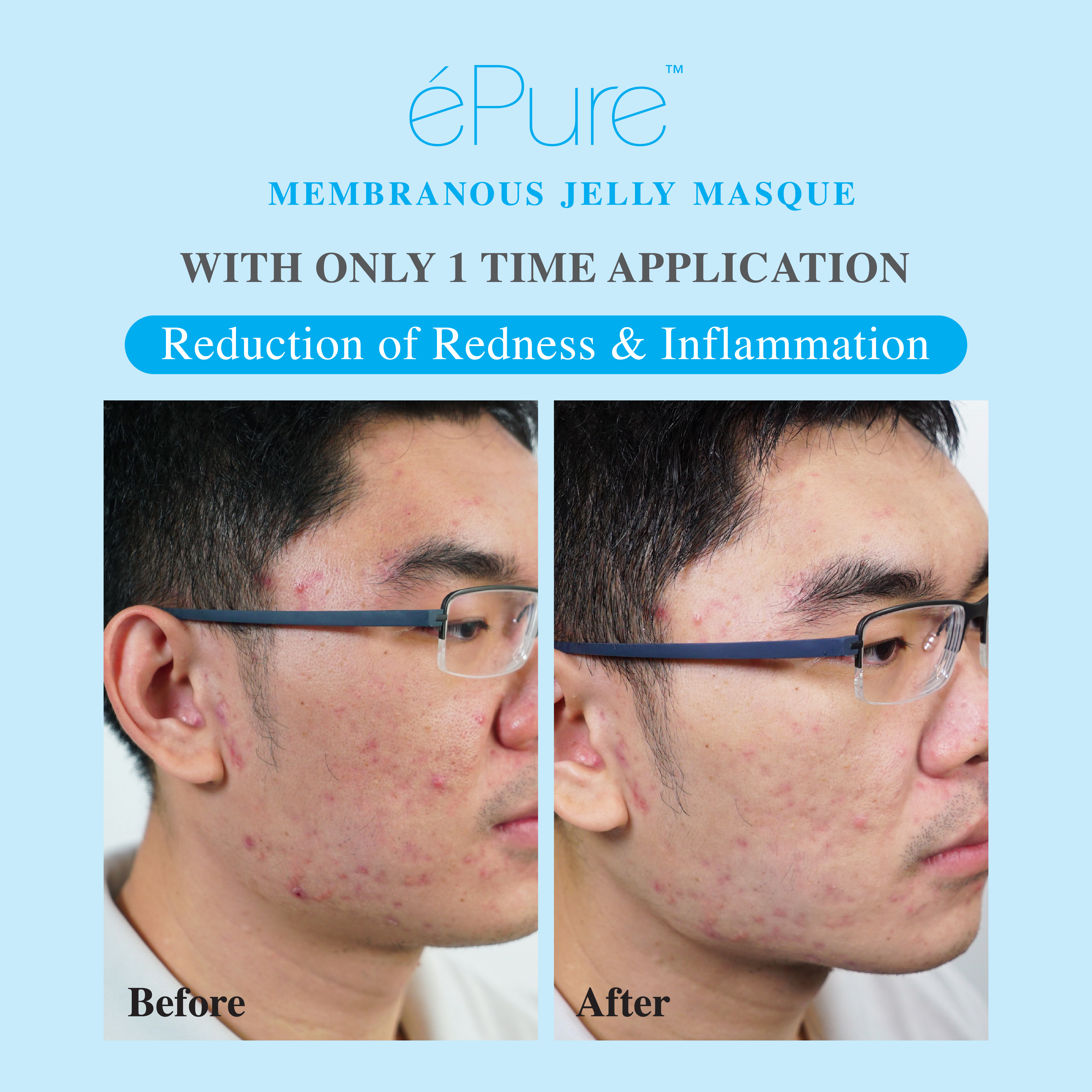 Customer testimonial before and after result after using &eacute;Pure Membranous Jelly Masque