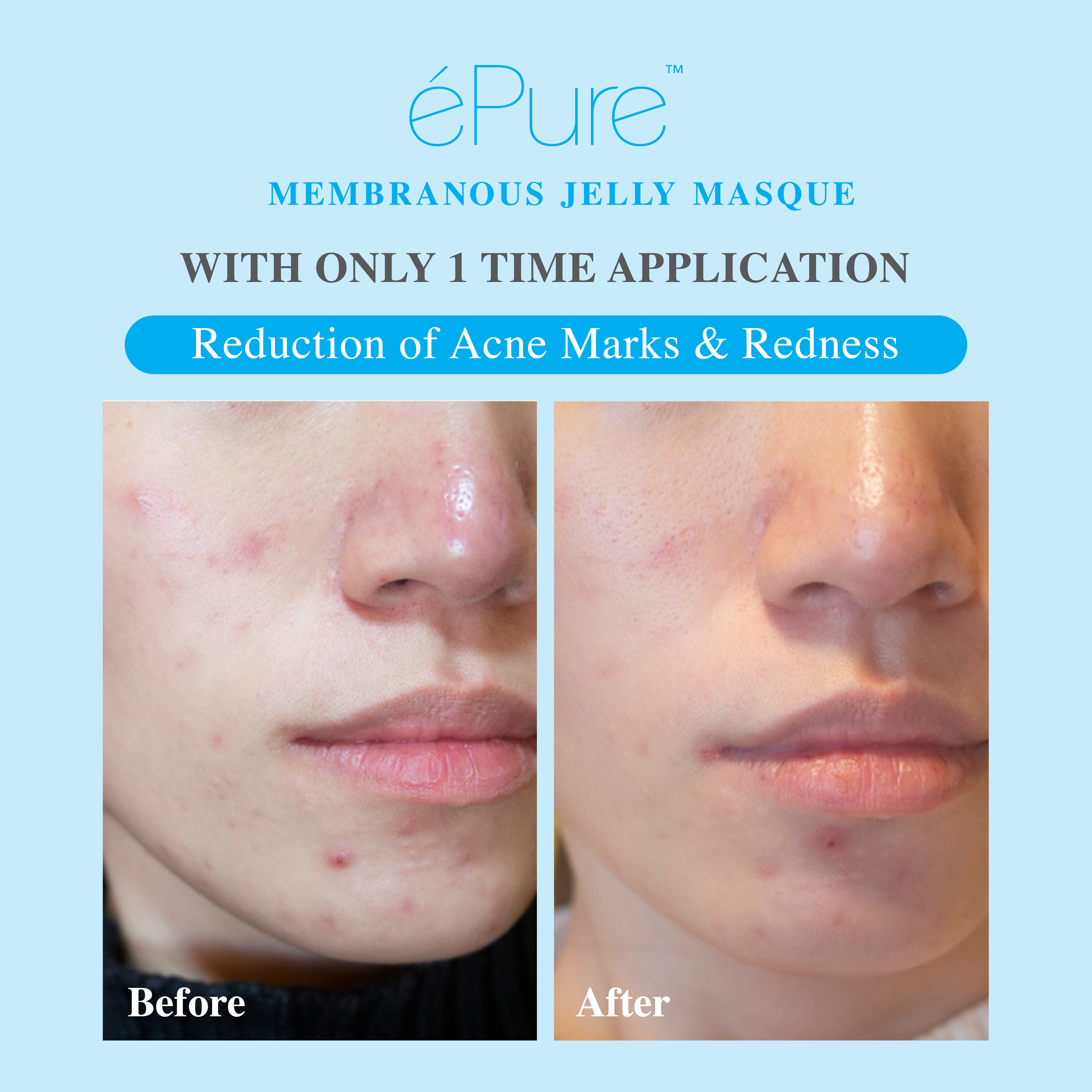 Customer testimonial before and after result after using &eacute;Pure Membranous Jelly Masque