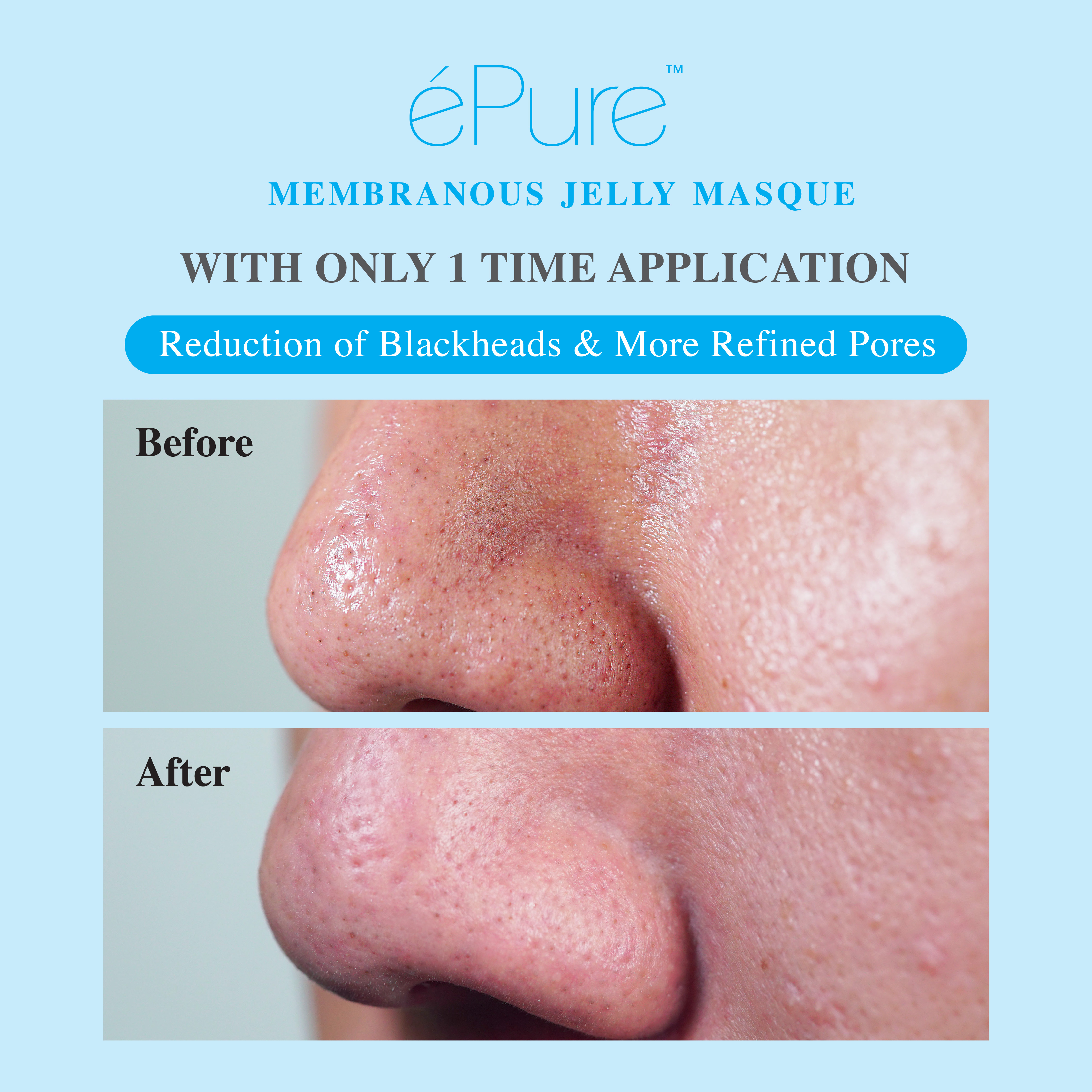 Customer testimonial before and after result after using &eacute;Pure Membranous Jelly Masque